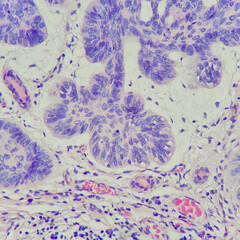 Camera photo of basal cell carcinoma of the skin tissue, showing tumor sheet with cleft artifact,...