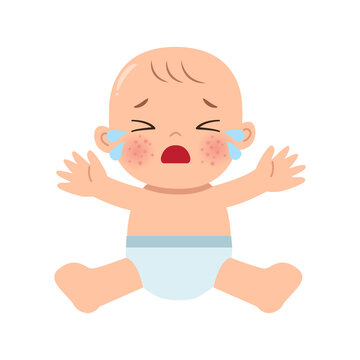 Baby Having Eczema Skin Problem On Face. Flat Vector Cartoon Design