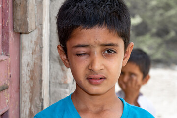 child boy with one eye disability