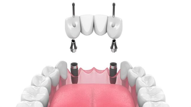jaw with dental bridge supported by implants over white background