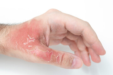 Fototapeta premium Man's hand with injuries and red dead skin on hand after thermal burn, domestic accident, careless behavior with boiling water on white background. Damage to hand after bursting glass with hot water.