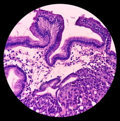 Microscopic image of Gastric carcinoid tumor, rare tumors that develop within the gastric mucosa....
