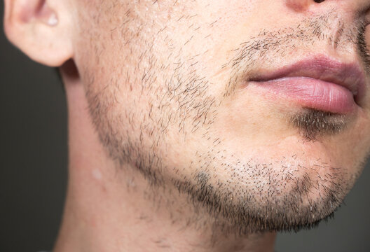 Short, sparse beard on mans face. Hair growth problems. Man with alopecia area in the beard. Unshaven bristles on the beard.