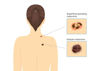2 spots lesions at the back of the skin disease patient. Superficial spreading melanoma and Nodular melanoma. Medical illustration for diagnosing and classifying. - obrazy, fototapety, plakaty