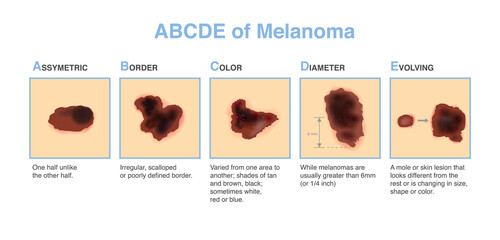 Different characteristics of skin damage. ABCDE stands for asymmetry, border, color, diameter, and evolving. Medical diagram for diagnosing and classifying melanomas and treatment.