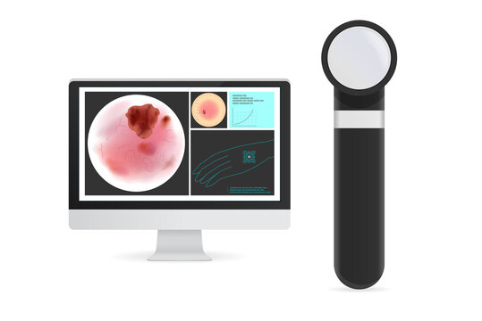 Dermoscopy and monitor with close up skin and chart on the screen for diagnosing of skin cancer disease, tumor. Illustration about binocular microscope of medical.