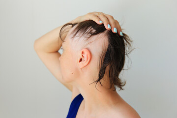 Hair loss in the form of alopecia areata. Bald head of a woman. Hair thinning after covid. Bald...