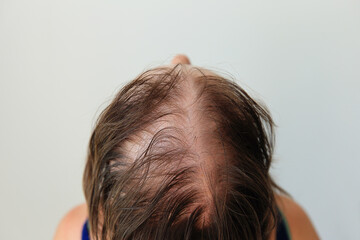 Hair loss in the form of alopecia areata. Bald head of a woman. Hair thinning after covid. Bald patches of total alopecia - obrazy, fototapety, plakaty