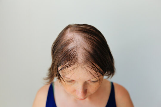 Hair Loss In The Form Of Alopecia Areata. Bald Head Of A Woman. Hair Thinning After Covid. Bald Patches Of Total Alopecia