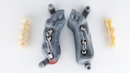two dental models with metal beams and two temporary bridges with prostheses on a white background