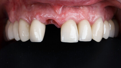 upper jaw without a central tooth before prosthetics on a black background © Dental Pro Content