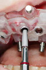 the moment before installing the dental implant in a special template