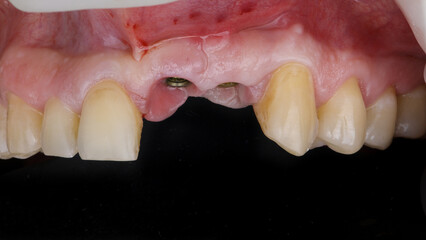 upper jaw after implantation before installing crowns on a black background © Dental Pro Content