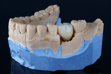 plaster model with a ceramic crown in the chewing area