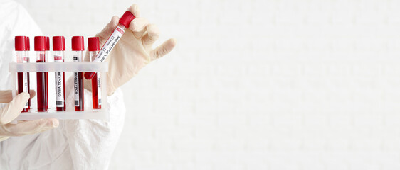 Scientist holding samples of monkeypox virus on white background with space for text, closeup