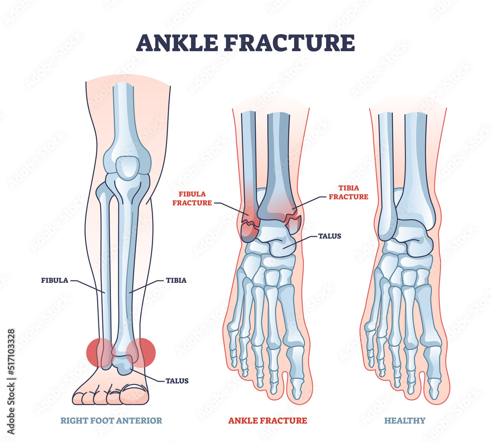 Poster Ankle fracture and right foot anterior trauma medical view outline diagram. Labeled educational scheme with anatomical comparison for healthy and fractured bones vector illustration. Leg tibia injury