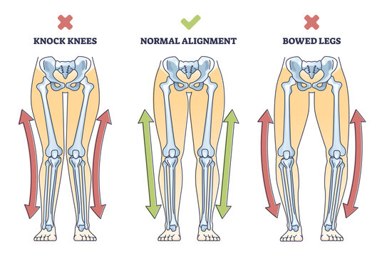 Bowed legs syndrome with normal and knock legs comparison outline diagram. Labeled educational physical defect with outward bending and knees does not touch vector illustration. Anatomical explanation