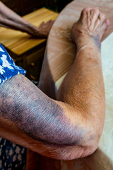 the hand of an elderly woman with bruises