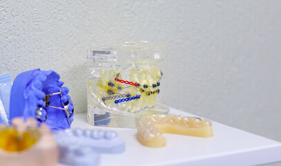 Dental model of the tooth jaw with metal braces and wire in a natural form. Model of installation of braces on teeth. Dental treatment.