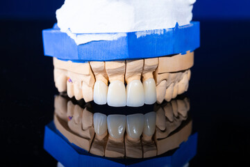 Frames of ceramic crowns on a gypsum model. Zirconia crowns. Metal-free ceramics at the manufacturing stage. Close-up, black isolate