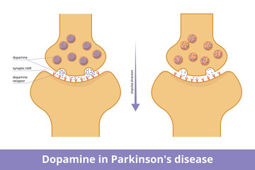 Dopamine in Parkinson's disease. Visualization of dopamine production decrease due to neurodegeneration that is closely bound to Parkinson's disease.