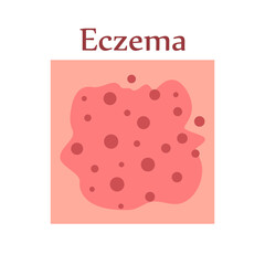 Eczema on human skin. Dermatological disease. The symptom is itching, pain, redness and rash. Allergic reaction. Medical diagnostics and treatment. Vector illustration