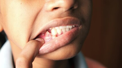 teenage boy with deformed teeth 