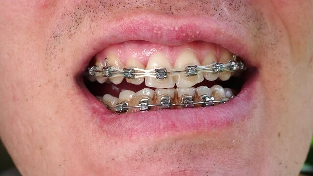 braces on the teeth of a man close up