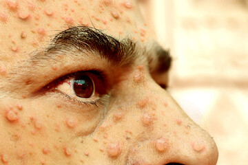 Monkeypox virus symptoms, its is infecting people,  Blisters on face, face full of smallpox, skin...