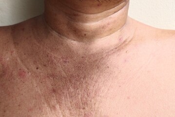 Portrait showing skin damage, irritation and dermatitis on the body, dullness acne and blemishes, problem wrinkles and neck wattle of the old man, concept health care. - obrazy, fototapety, plakaty