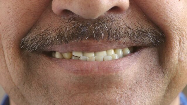 Man with uneven, yellow teeth smiling. Evidence before dental treatment of a mature adult male who gets their teeth whitened and gets braces to have them made straight. Teeth stained from smoking