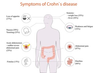 Vector illustration of Crohn`s disease symptoms