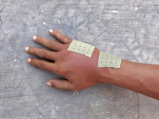 Swollen back of the palm due to dislocated of the bones or insect bee sting