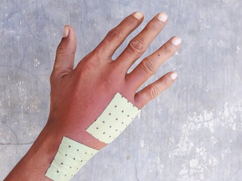 Swollen back of the palm due to dislocated of the bones