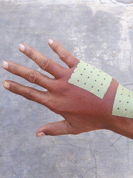 Swollen back of the palm due to dislocated of the bones or insect bee bite