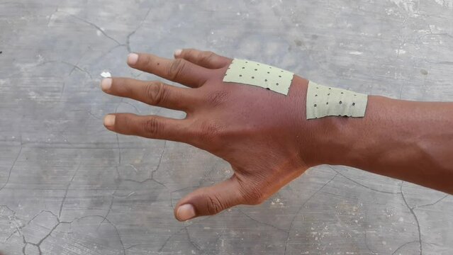 Swollen back of the palm due to dislocated of the bones