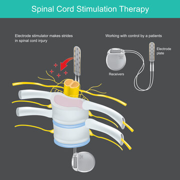Spinal Cord Stimulation Therapy. A electronic tool implant in body use for neck and back pain therapy..
