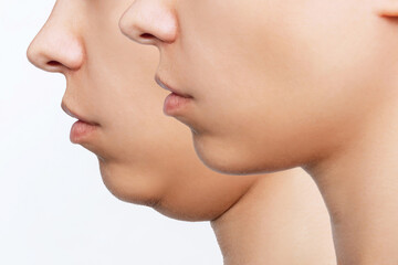 Liposuction of double chin. Cropped shot of woman's face with chin before and after cosmetic...