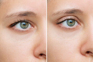 Close up of a young caucasian woman's face with drooping upper eyelid before and after blepharoplasty isolated on white background. Result of plastic surgery. Changing the shape, cut of the eyes - obrazy, fototapety, plakaty