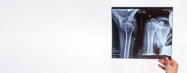 Banner with hand holding shoulder, clavicle X-ray image. Acromion, acromial end fracture. Health care, medical examination, arm injury detection concept. Copy space. High quality photo