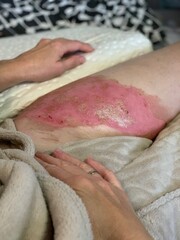 Wound after skin burn with boiling water.