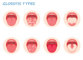 Types glossitis. Inflammatory disease tongue, vector illustration