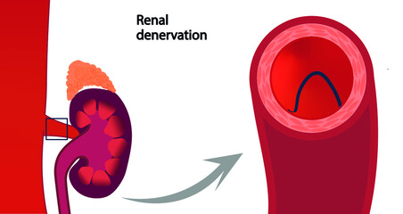 Renal denervation illustration. RDN treatment for hypertension. Renal artery cross section view