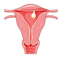 Pedunculated Polyp in the uterus Female reproductive system in cross sections. Front view in a cut. Human anatomy diseases internal organs location scheme, cervix, ovary flat style icon