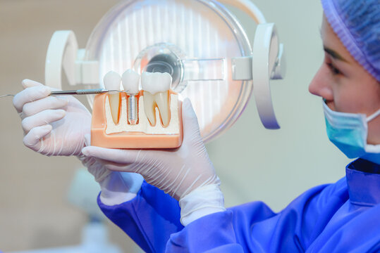 Dentist showing human teeth model and pointing to crown of Dental Implant. Knowledge about dental implants and caring for healthy teeth. Medical treatment at modern dental clinic or dentist office.