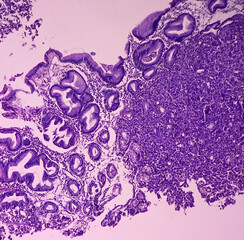 Microscopic image of Gastric carcinoid tumor, rare tumors that develop within the gastric mucosa. Neuroendocrine tumor (NET), which presented as a gastric polyp