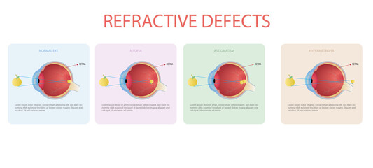 Refractive errors of vision,myopia,hyperopia,astigmatism - obrazy, fototapety, plakaty