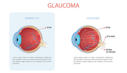 Infographic of a normal eye and an eye with glaucoma, the arrows indicate the internal pressure of the eye.