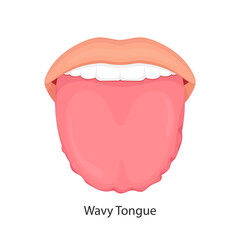 swollen enlarged white tongue with wavy ripple scalloped edges (medical name is macroglossia) and lie bumps