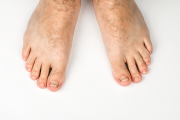 Fungal infection on the toenails of the foot, on a white background.